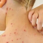 Непривитых детей будут временно отстранять от школ и детсадов при выявлении кори